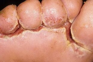 simptomi glivic na nohtih