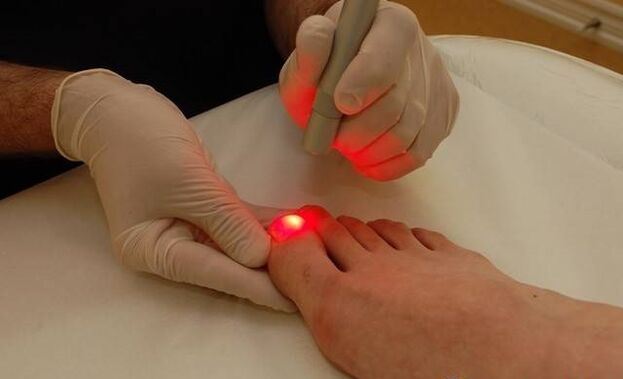 lasersko zdravljenje glivic na nogah