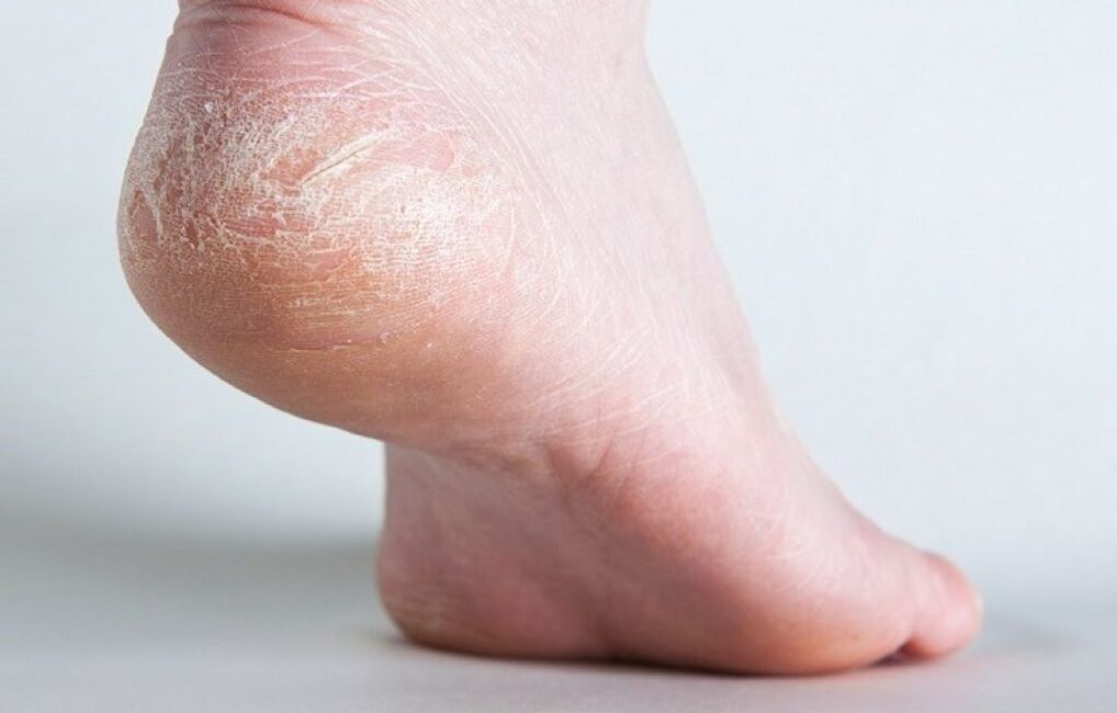 kožne glivice na nogah kako zdraviti