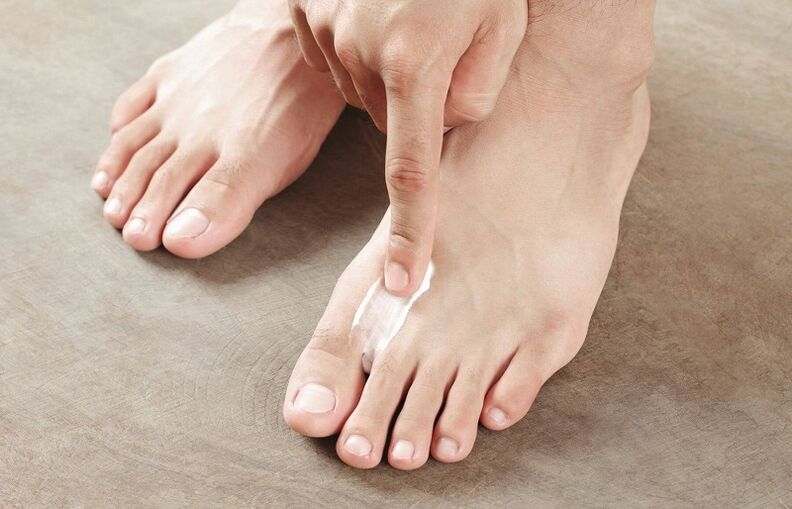 mazilo za zdravljenje glivic na nohtih