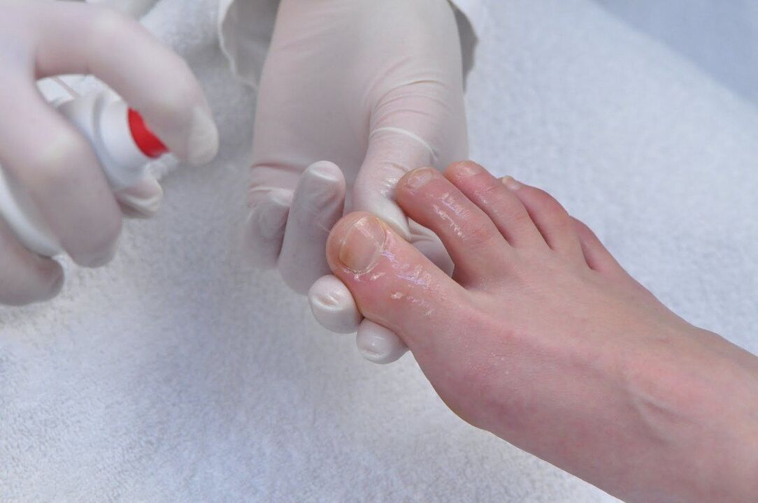 zdravljenje glivic na nohtih