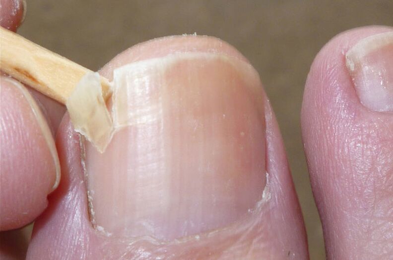 Poškodovani nohti so dejavnik tveganja za glivično okužbo