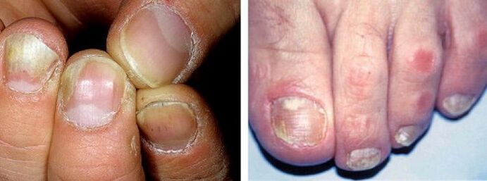 manifestacije glivične okužbe na nohtih