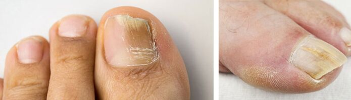 fotografija glivične okužbe na nohtu palca na nogi