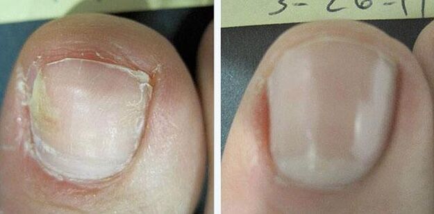 pred in po zdravljenju glivic na nohtih