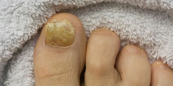 rumeni noht na nogi z glivično okužbo