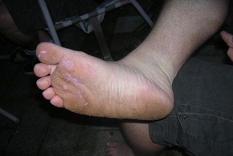 glivično stopalo