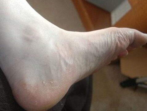 luščenje stopala noge kot znak glivične okužbe